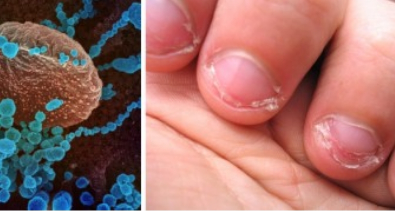 Experten warnen: An den Nägeln kauen kann das Risiko erhöhen das Coronavirus zu bekommen.
